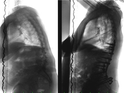 Rentgenové snímky páteře pacientky před operací a po ní. 