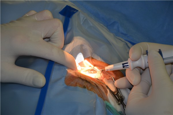 Zavedení gelového implantátu XEN ke snížení nitroočního tlaku. Foto: KZ, a. s./Petr Sochůrek