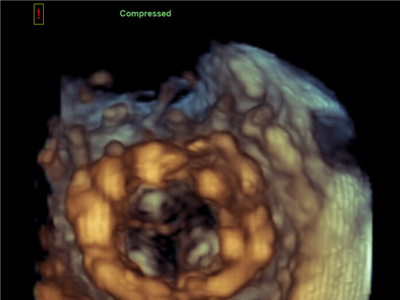 Trojrozměrná echokardiografie zobrazující ideálně implantovanou chlopeň.