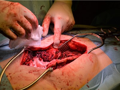 Neurochirurgové v Krajské zdravotní používají na deformity páteře jako první v Česku tyče vyrobené pacientovi na míru